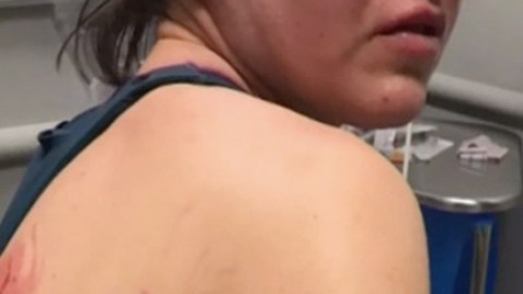 Las heridas de Caitlin Keen por el ataque de Taco.