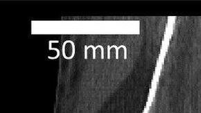 La flecha señala dónde se encuentra el hueso fabela.