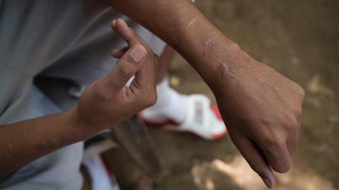 El excarcelado 'preso político' Jefry José Ortega Orozco muestra las heridas que asegura le hizo la policía al momento de su detención,.
