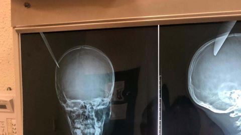 Las radiografías tomadas al menor herido.