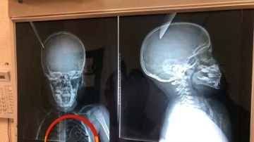 Las radiografías tomadas al menor herido.