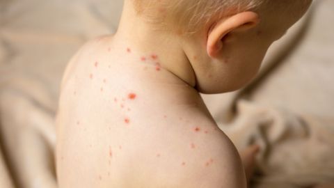 Director de CDC dijo que están trabajando para convencer al más del 5% de personas que deciden no vacunar a sus hijos para que entiendan su importancia.