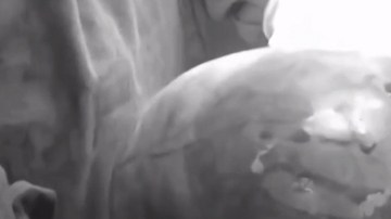 El tumor en el ovario pesaba 7 kilos (aproximadamente, 14 libras).