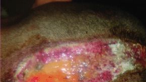 Así le dejaron la cabeza después de colorearle el cabello.