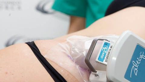 Al criolipólisis da los mismos resultados que una liposucción y es menos invasiva.