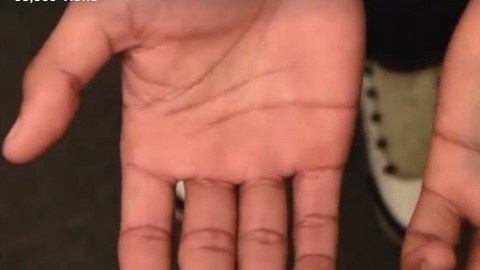 La mano herida de García