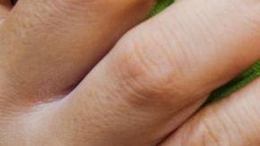 Este año, Estados Unidos ha informado de 704 casos confirmados de sarampión en 22 estados, en comparación con 372 casos en 2018, 120 casos en 2017 y 86 casos en 2016.