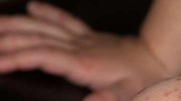 La mejor manera de protegerse contra el sarampión es vacunándose.