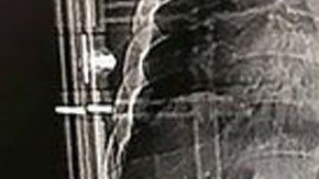 builder-impaled