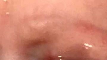 El niño fue contagiado del virus del herpes simple.