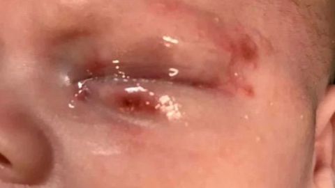 El niño fue contagiado del virus del herpes simple.