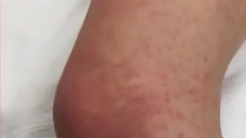La erupción de la menor y sus ratas.