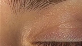 Gibson Miller antes y después de la cirugìa