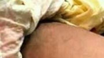 Bebé nació con una protuberancia llamada comúnmente "cola de ratón".