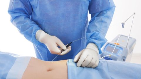 liposuccion-laser