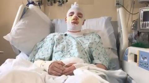 El joven sufrió quemaduras hasta de 4° grado.