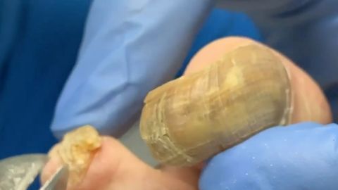 Los hongos en las uñas de los pies aparecen por mantenerlas húmedas y calientes.