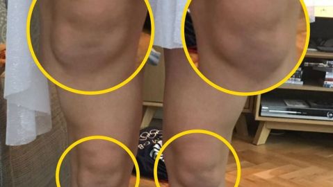 Las rodillas de Beth parecen dos caras de bebé.