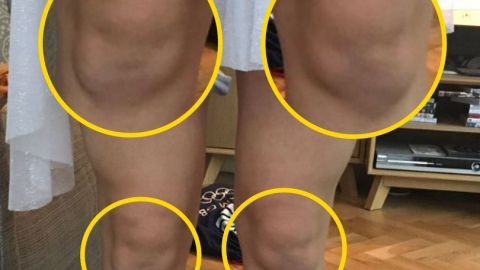 Las rodillas de Beth parecen dos caras de bebé.