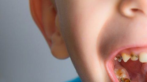 108255487_caries