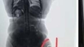 Agentes de seguridad detectaron cuerpos extraños en las piernas de la viajera.