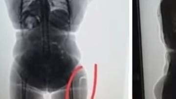 Agentes de seguridad detectaron cuerpos extraños en las piernas de la viajera.
