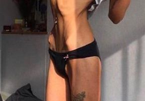 Una víctima de anorexia.