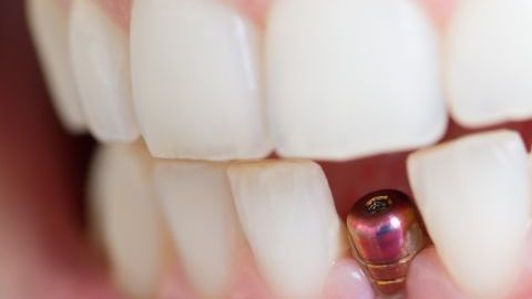 implante-dental-2