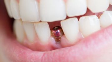 implante-dental-2