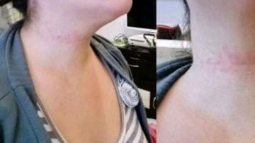 Así quedó el cuello de la víctima.