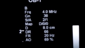 ultrasonido