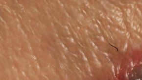 El melanoma se consideraba intratable hasta hace poco.