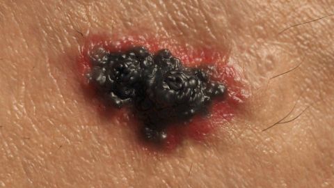 El melanoma se consideraba intratable hasta hace poco.