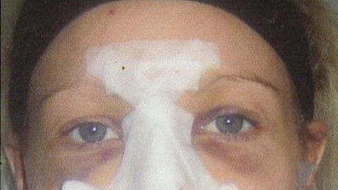 Catherine Roan quedó como si hubiera sufrido un "accidente automovilístico" después de una cirugía estética.