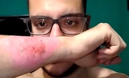 Así quedó su brazo después de eliminar el tatuaje