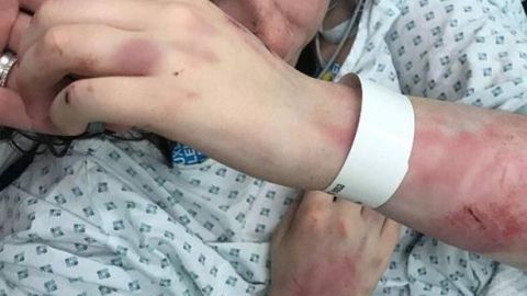 Emily Harvey todavía tiene problemas en los ligamentos de su mano debido al ataque.