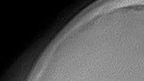 Esta radiografía nuestra cómo es insertado un implante cerebral.