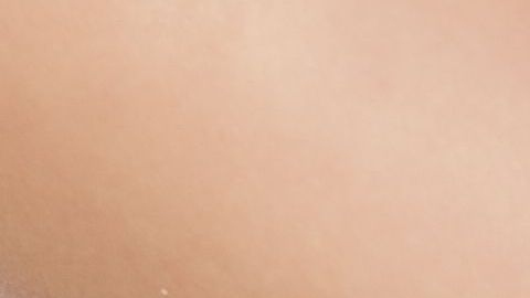 candidiasis