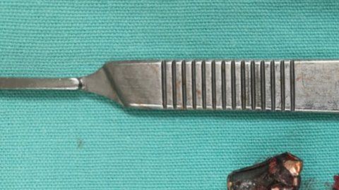 El fragmento de bala que lograron sacarle de la cabeza. Los doctores no pudieron remover algunas esquirlas.