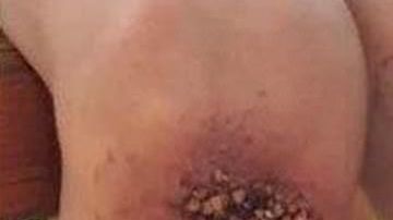 El niño tuvo que ser intervenido por las terribles heridas que le causó el castigo.