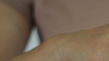 Las personas que tienen dermatilomanía pueden pellizcar o rascar lunares, pecas, marcas o cicatrices para "suavizarlos" o "perfeccionarlos".