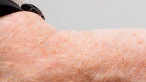 La septicemia es causada cuando el sistema inmune entra en colapso y, en lugar de combatir una infección, también comienza a atacar otras partes del cuerpo.