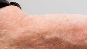 La septicemia es causada cuando el sistema inmune entra en colapso y, en lugar de combatir una infección, también comienza a atacar otras partes del cuerpo.