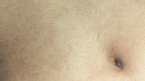 El POIS es un trastorno poco común.