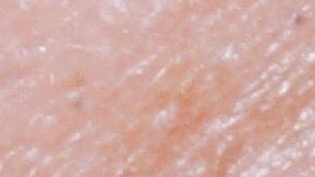 Un problema hormonal provoca esta extraña condición.