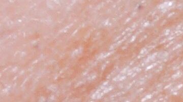 Un problema hormonal provoca esta extraña condición.