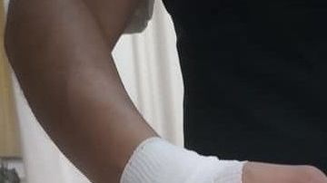 Sandra Alemán Arellano mostró sus dedos fracturados.