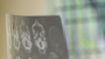 Doctora revisando tomografía cerebral