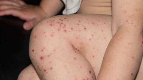 Los niños son especialmente vulnerables al sarampión. (archive)