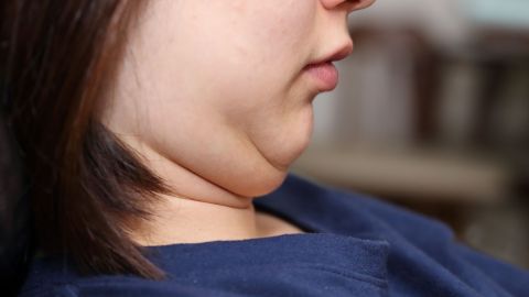 papada gorda obesidad
